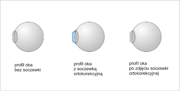 Ortorekcja